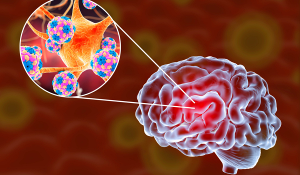 What You Need To Know About Encephalitis And Its Causes