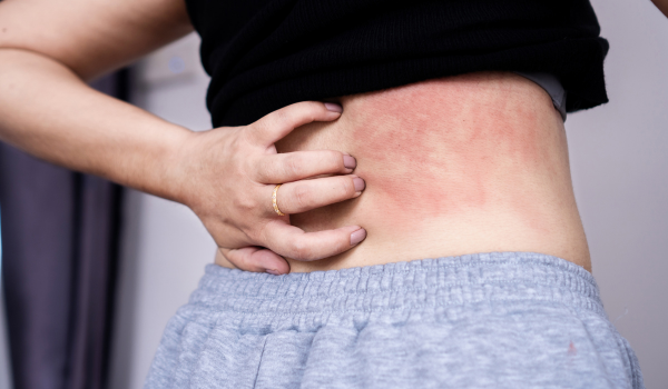 What Does HIV Rash Look Like—and How Do You Treat It?