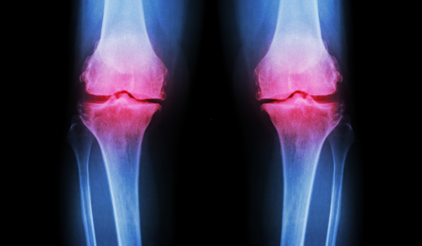 Signs and Symptoms of Osteoarthritis