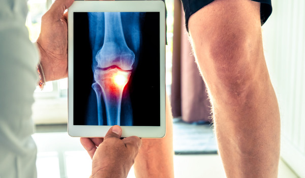 Osteoarthritis: What It Is and How It Impacts Your Life