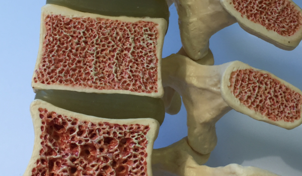 Signs and Symptoms of Osteoporosis