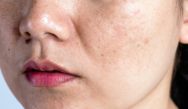 What Triggers Skin Discoloration and How to Effectively Manage It