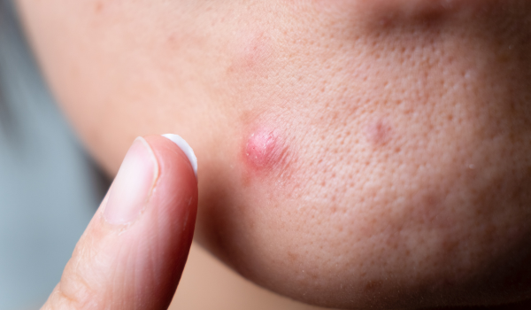 Comprehensive Guide To Understanding And Treating Cystic Acne