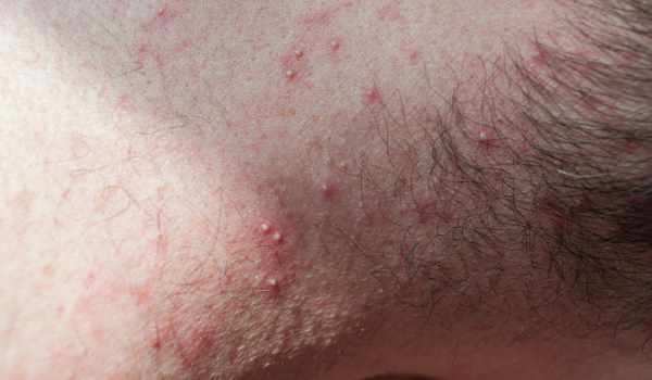 Understanding Inflammatory Acne And Effective Ways To Treat It