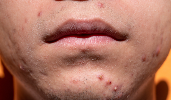 Fungal Acne: Causes, Symptoms, and How to Treat It Effectively