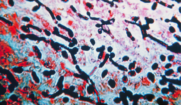 Major Risk Factors for Esophageal Cancer