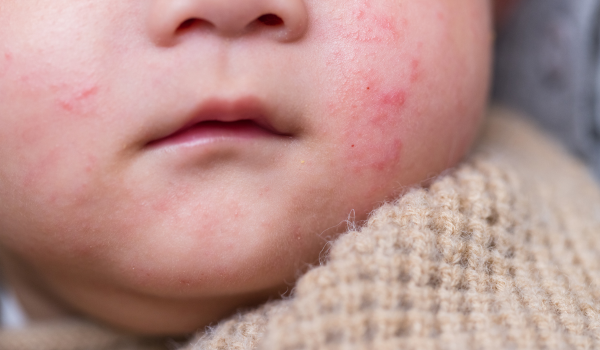 Can Eczema Spread?