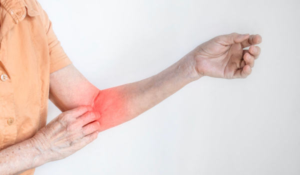 What Is Nummular Eczema