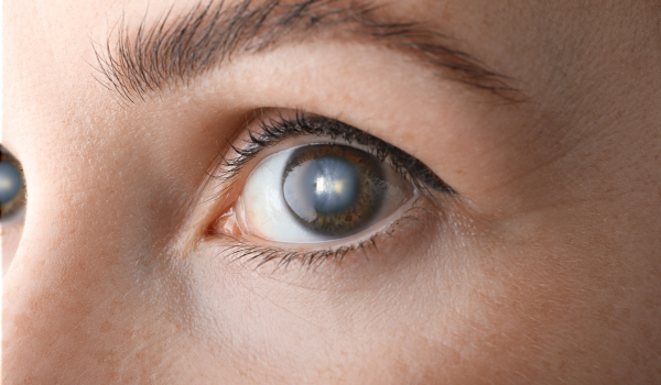 Signs and Symptoms of Cataracts