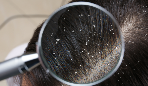 Everything You Should Know About Dandruff and How To Manage It