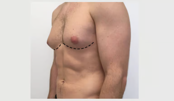 Signs and Symptoms of Low Testosterone