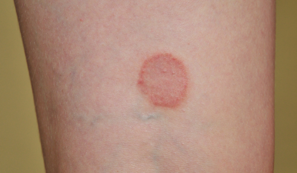 Ringworm: Everything You Need to Know About This Fungal Infection