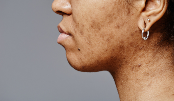 How To Effectively Fade Acne Scars: Treatments And Prevention
