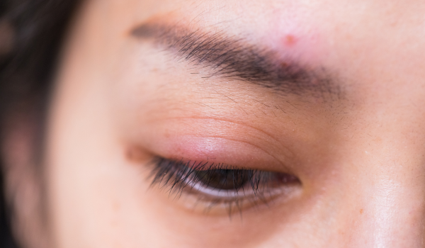 How To Safely Get Rid of a Stye at Home or With Treatment