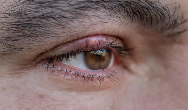 What Is a Stye (Hordeolum)?
