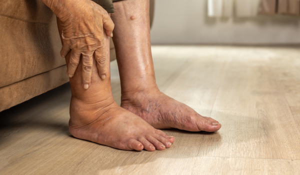 Understanding Cankles and How To Treat Ankle Swelling