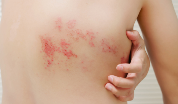What You Need to Know About Shingles and Its Causes