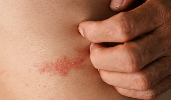 What You Need to Know About Shingles and Its Treatment