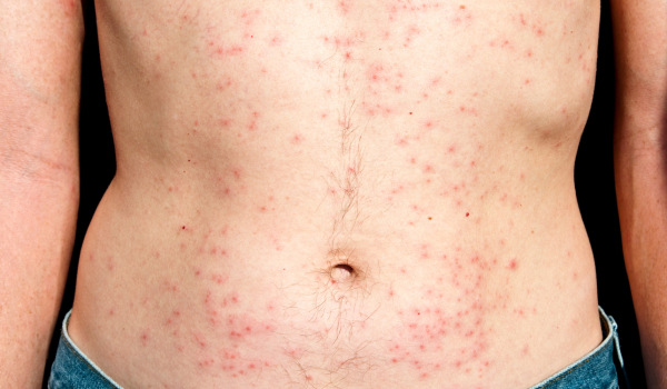 What’s Behind Those Red Bumps on Your Skin? Possible Causes and Solutions