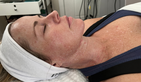 Understanding Skin Discoloration: Causes And Treatments For Hyperpigmentation