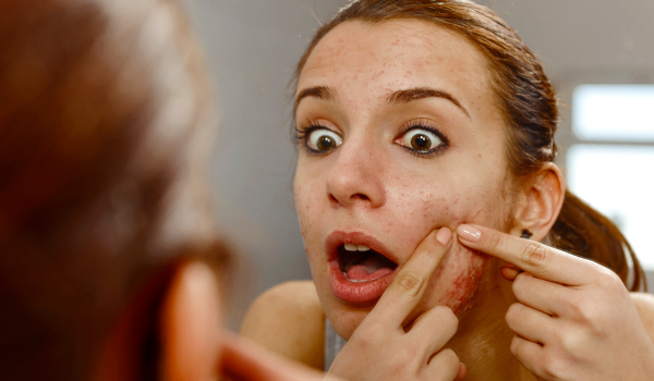 What You Should Know About Cold Sores And Acne Breakouts