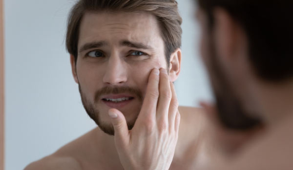 Does Whey Protein Trigger Acne Breakouts? What To Know About The Connection
