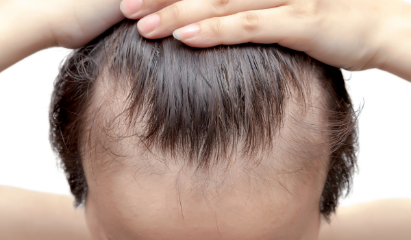 What Causes Alopecia (Hair Loss)