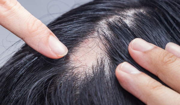 Signs and Symptoms of Alopecia