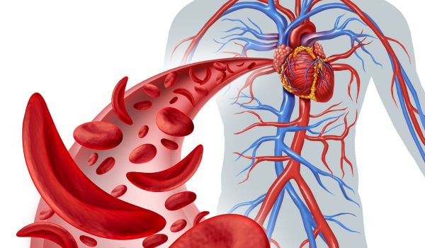 What To Know About Sickle Cell Disease (SCD)