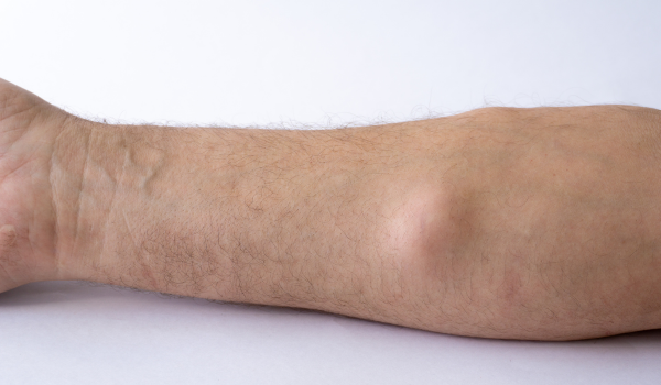 Signs And Symptoms Of Lipoma