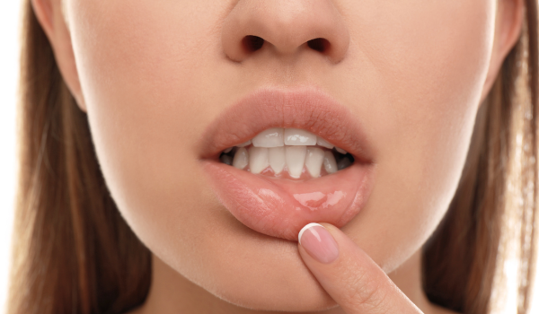 How To Get Rid of Cold Sores