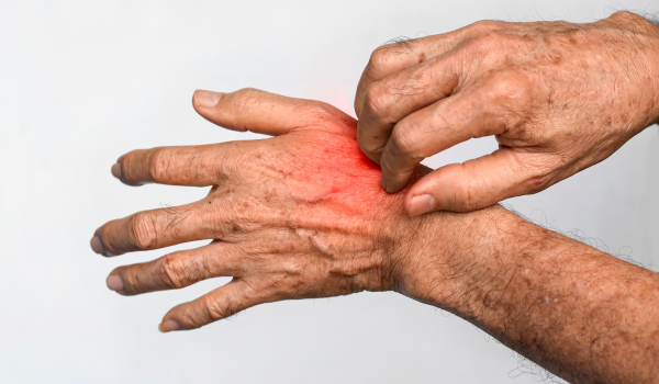 What Are Skin Infections?