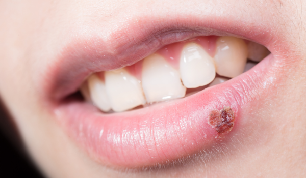 Signs and Symptoms of Cold Sores