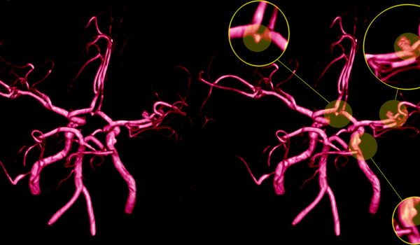 What Is an Aneurysm?