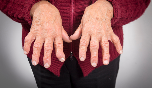 How Does Psoriatic Arthritis Affect Your Nails?