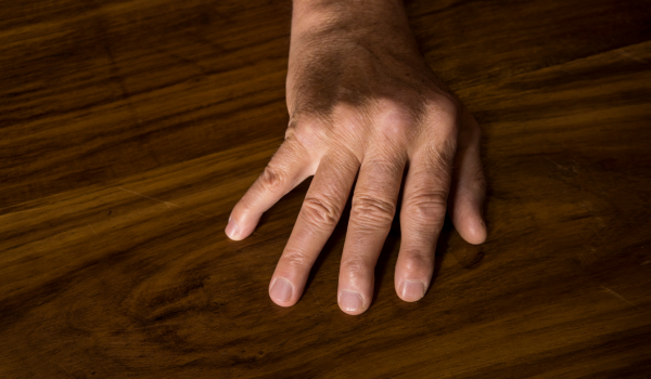 What Does Psoriatic Arthritis Feel Like?