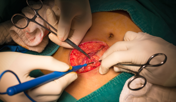 Appendectomy (Appendix Surgery): Procedure, Recovery, and Risks