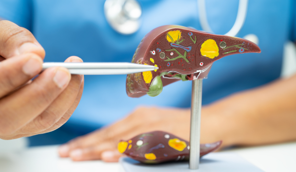 How To Treat Gallstones
