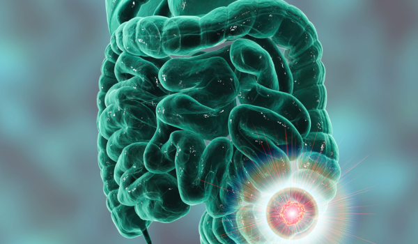 How Common Is Dying From Small Bowel Obstruction?