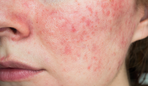Understanding Rosacea: Symptoms, Causes, and How to Treat It