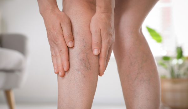 What Is Venous Stasis (Stasis Dermatitis)?
