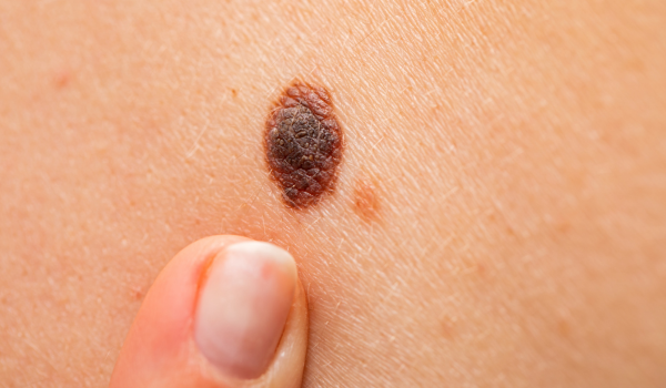 The Stages of Melanoma