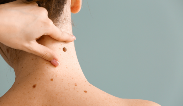 Signs and Symptoms of Melanoma