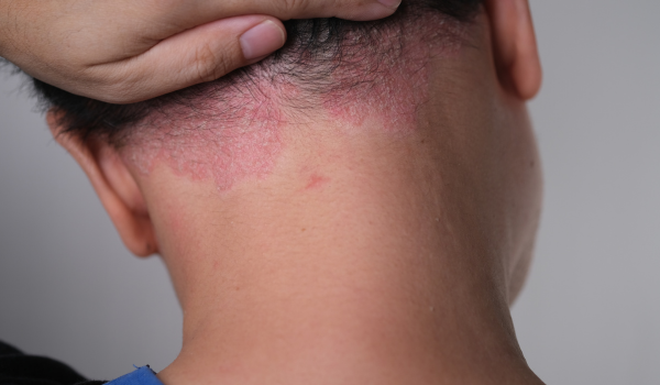 How Psoriasis Affects Your Skin and Overall Health