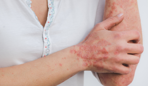 Can Psoriasis Cause Skin Infections?