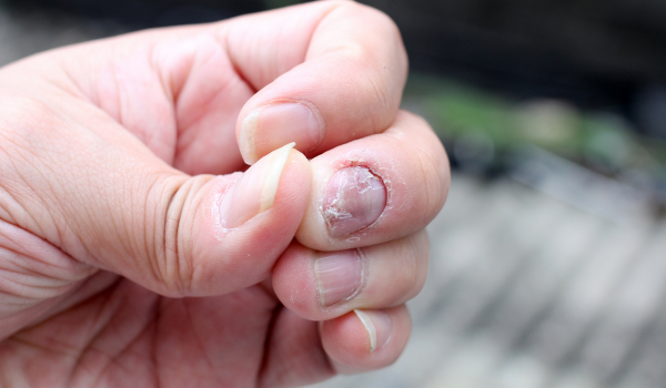 Nail Psoriasis: How It Affects Your Nails and What You Can Do