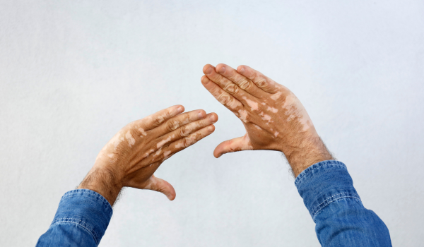 How To Prevent Vitiligo?