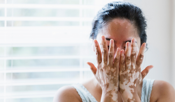 How Is Vitiligo Diagnosed?