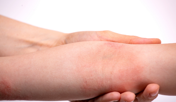 A Promising Breakthrough in Eczema Treatment: Join the Clinical Study for an Investigational Injectable Medication