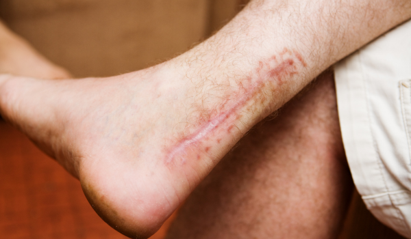 What Does It Mean To Tear Your Achilles Tendon?